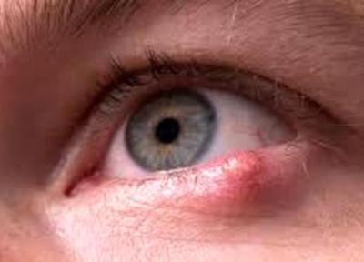 تبخال چشمی چیست و چگونه درمان میشود؟